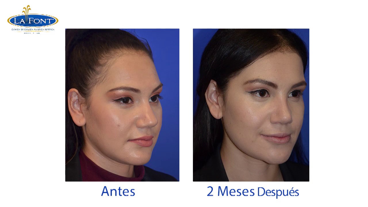 RINOPLASTIA PRIMARIA EN MUJERES JÓVENES - DR. FERNANDO PEDROZA - BOGOTÁ COLOMBIA