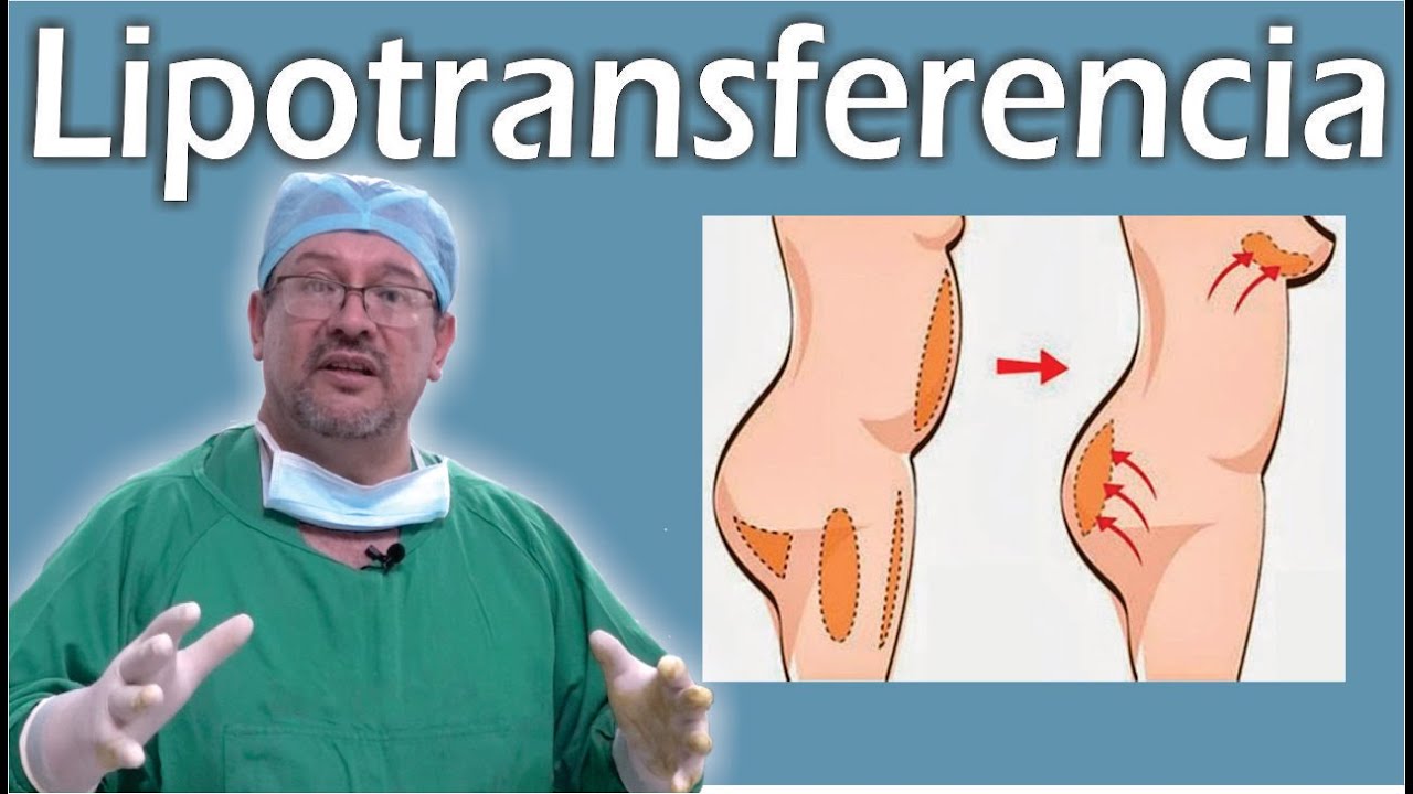 TODO SOBRE la LIPOTRANSFERENCIA 👙  transferencia a GLÚTEOS y MAMAS  ❤️ El Dr ALBERTO CALVO RESPONDE
