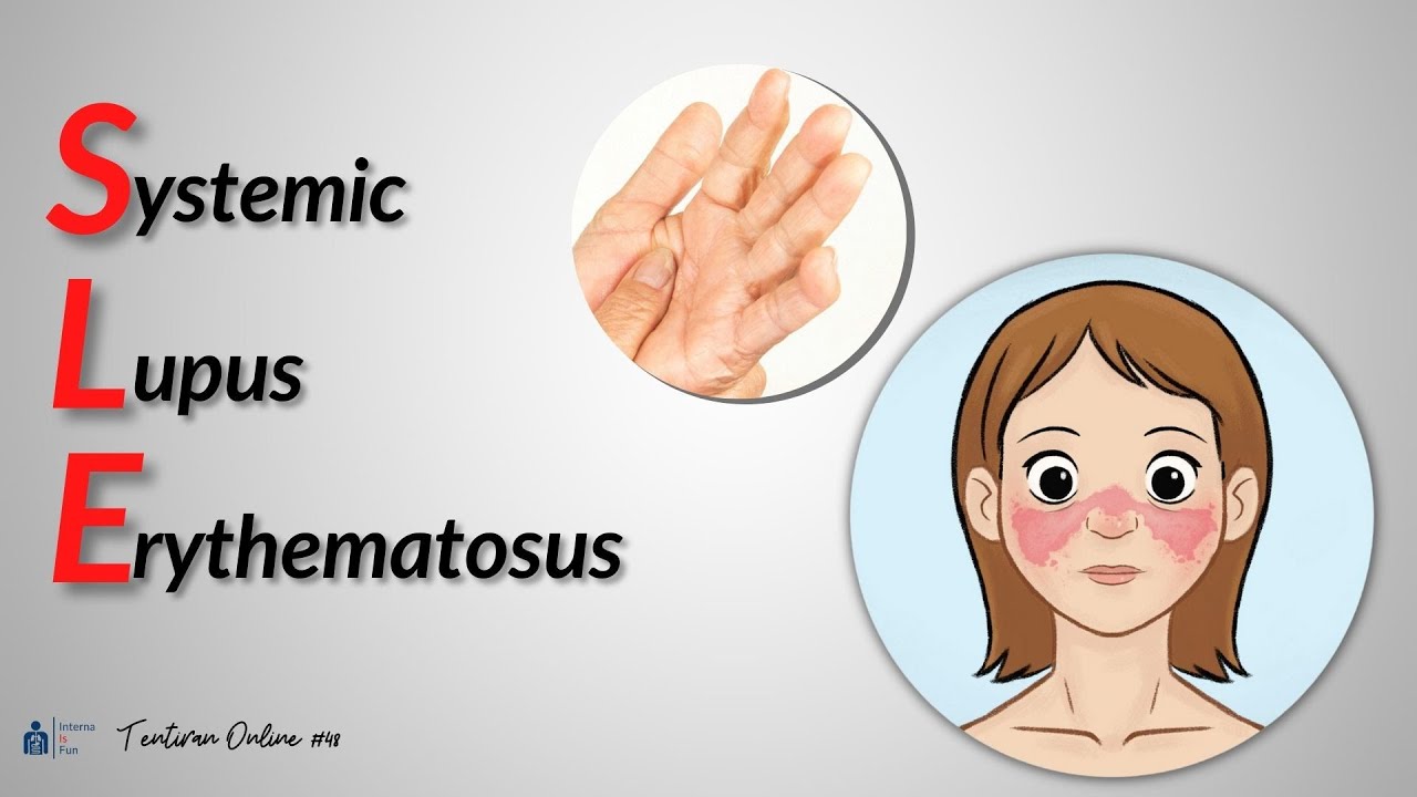 Systemic Lupus Erythematosus 101 | TENTIRAN ONLINE