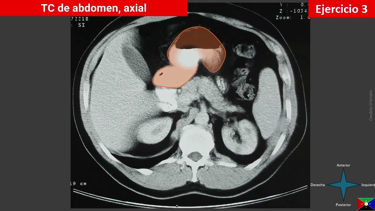 Tomografía computada de abdomen supramesocolico - parte C
