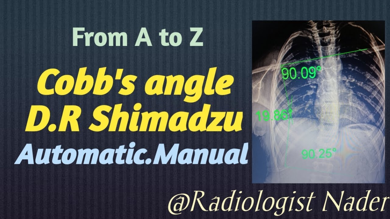 قياس زاوية اعوجاج العمود الفقري|جهاز دي آر شيمادزو|Cobb's(Scoliosis)Angle measurement|DR| Shimadzu