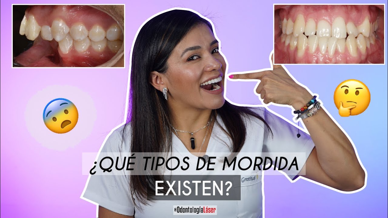 Tipos de mordida  😁 ¿Cuales existen? Aquí te lo contamos - Odontología Láser