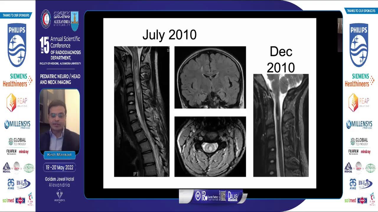 Pediatric Demyelinating Diseases (MS-NMO-Anti-MOG)