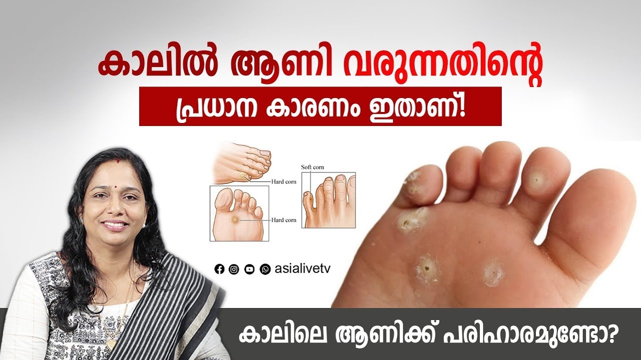 The Main Cause of Foot Corns! Symptoms, Causes & Treatment Explained