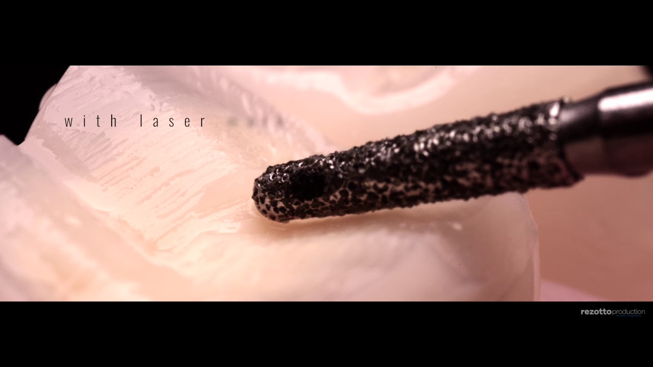 Preparation of Occlusal Onlay - OccluShaper [Step-by-Step]
