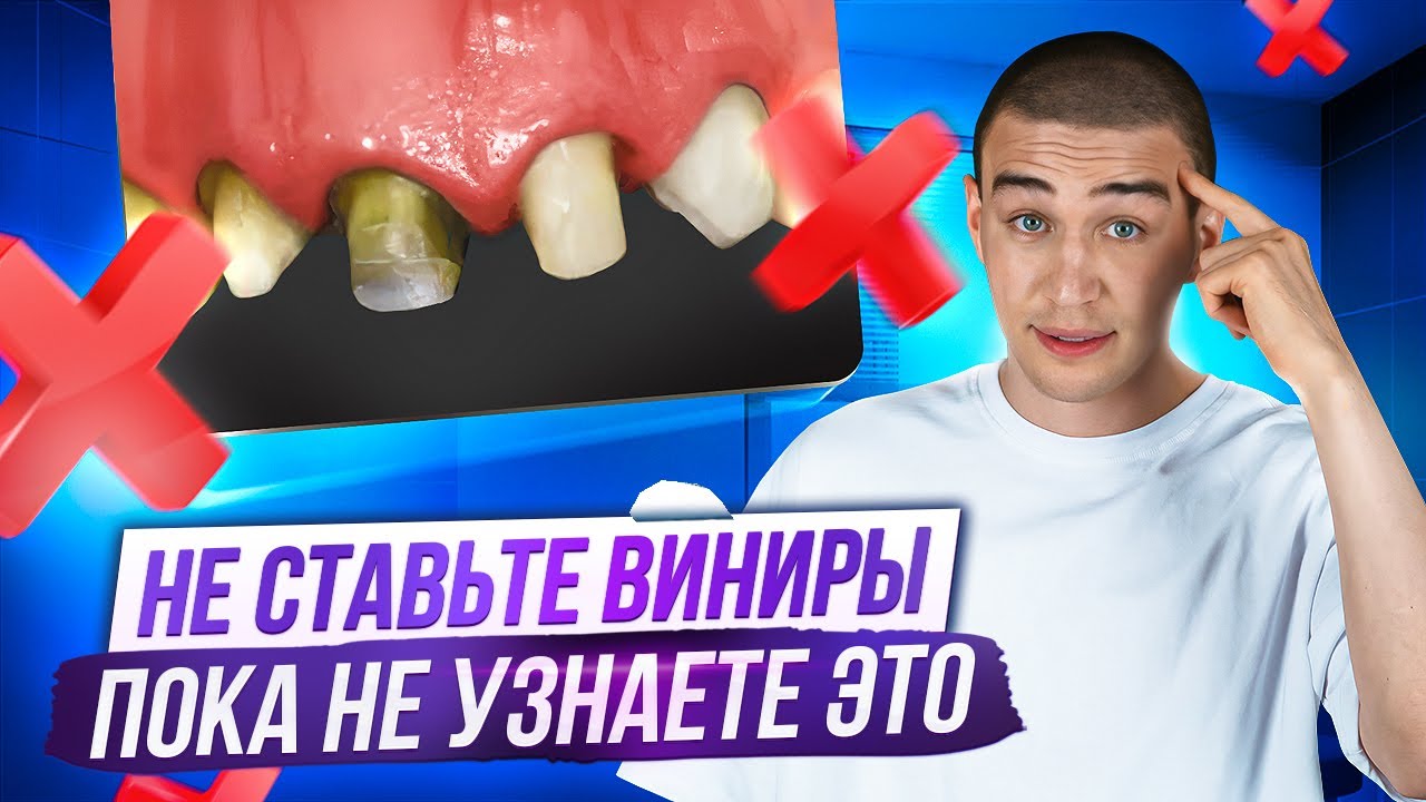 Эта ошибка при выборе ВИНИРОВ будет стоить вам зубов!