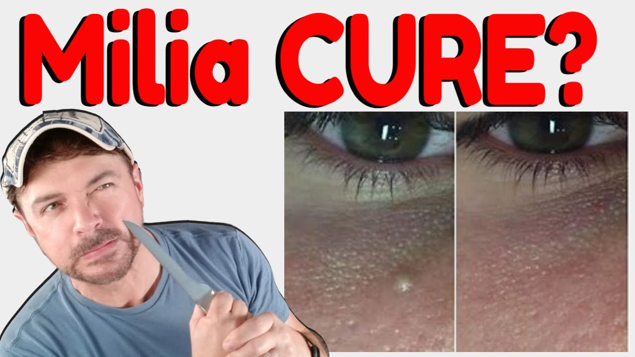 Easy Ways To Get MILIA FREE Skin Now!