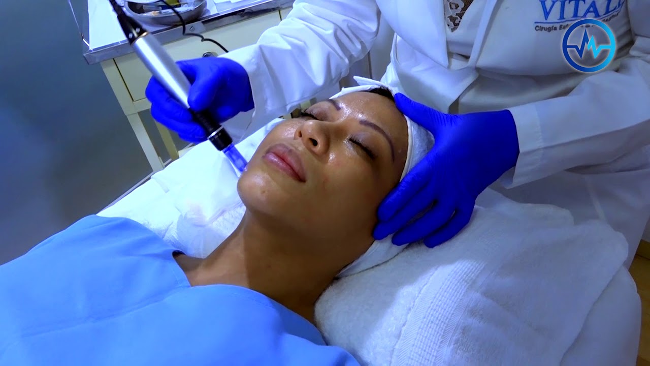 ÁCIDO HIALURÓNICO Y PLASMA - DERMAPEN - CLINICA VITALIS
