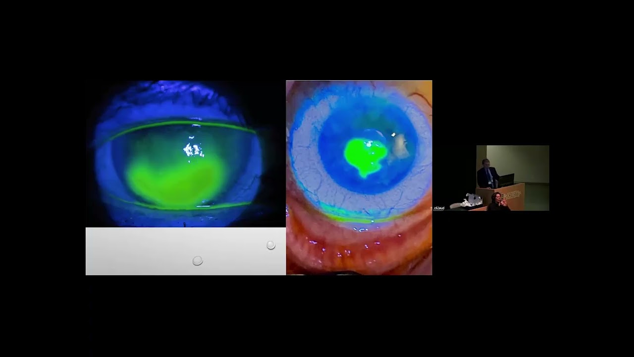 2025 Rochester Ophthalmology Conference: Ross Debates