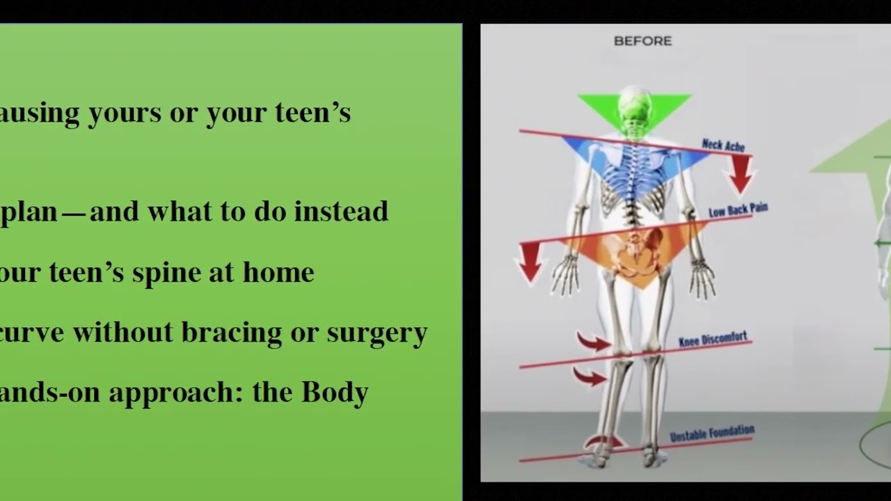 Scoliosis workshop