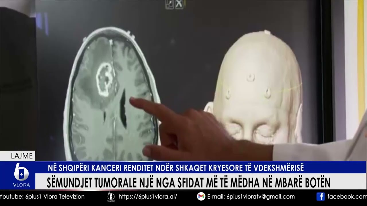 Sëmundjet Tumorale një sfidë mbarë botën. Në Shqipëri Kanceri ndër shkaqet kryesore të vdekshmërisë