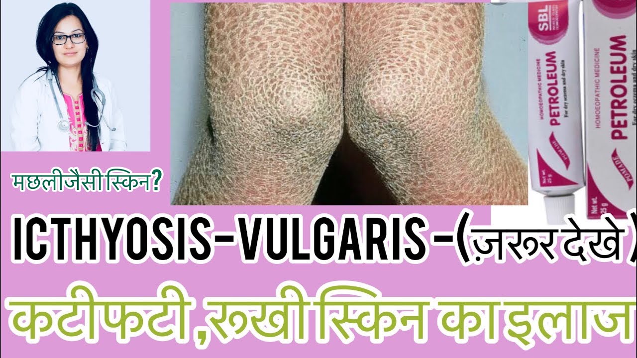 स्किन पे क्रैक्स—?Icthyosis रूखी स्किन?(Best homeopathic Medicine For Icthyosis vulgaris|-Dr.Rukmani