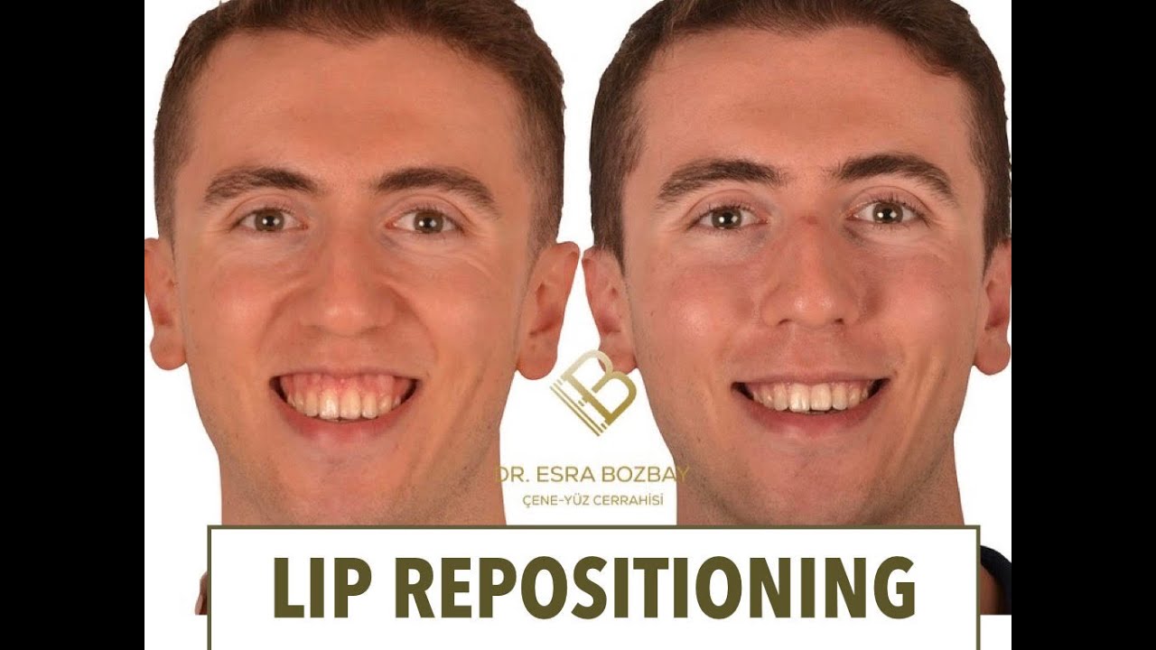 DİŞ ETİ GÜLÜMSEMESİ AMELİYATI SONUCU / GUMMYSMILE / PEMBE ESTETİK/ LIP REPOSITIONING