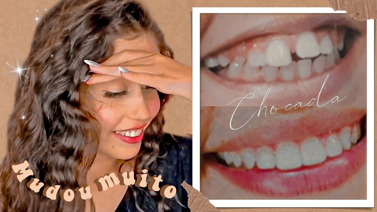 MEUS DENTES ANTES DO APARELHO