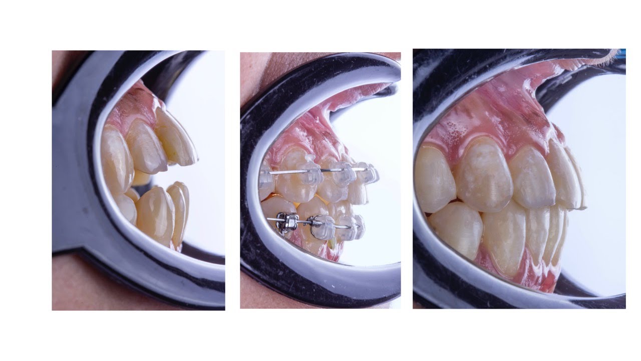 Open Bite + Cl III Case with Damon Clear Brackets