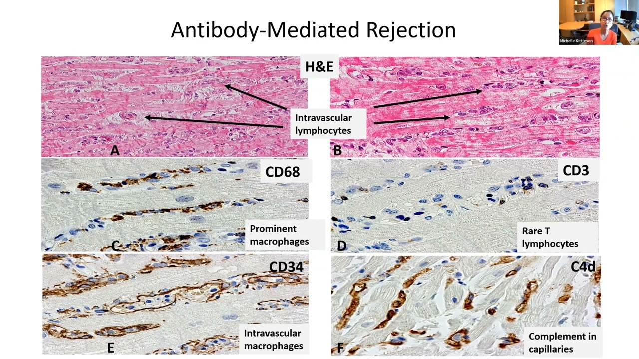 Approach to Antibodies in Heart Transplantation | Michelle Kittleson