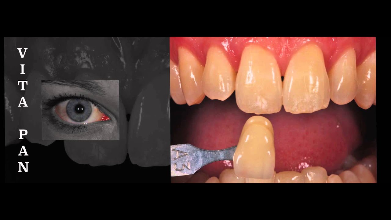 Shade selection for direct resin composite tip
