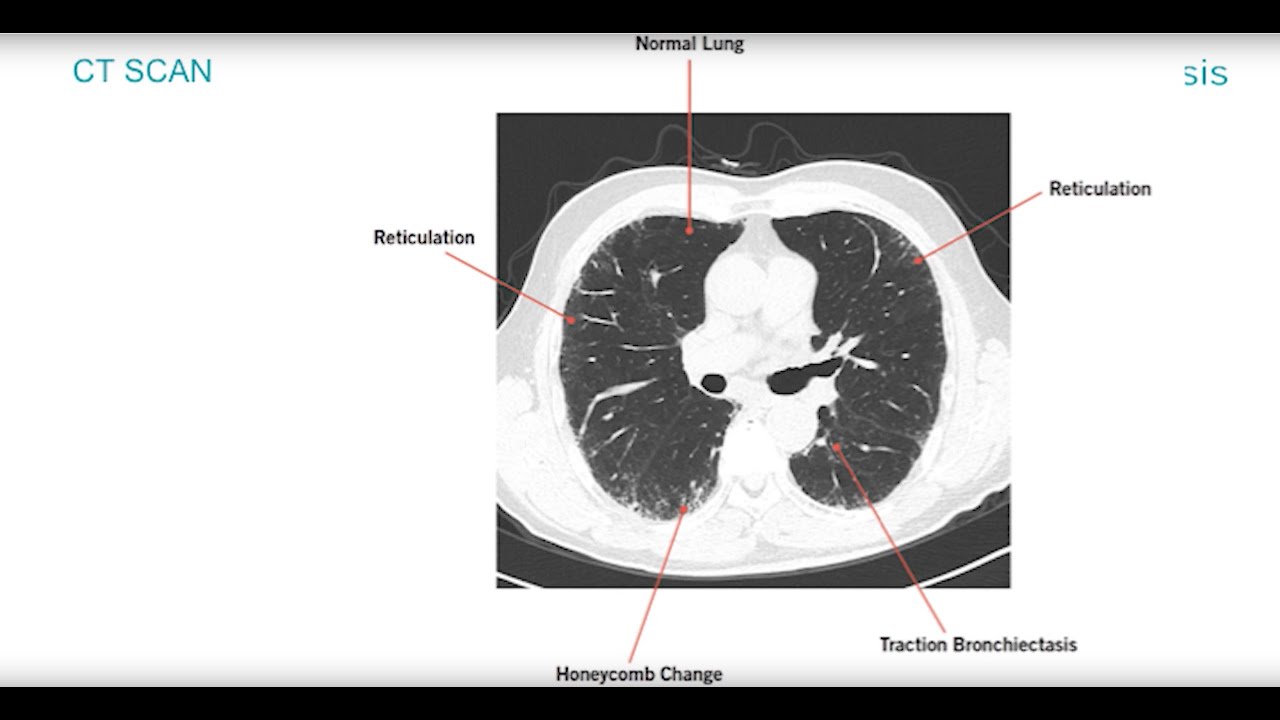 The Diagnostic Process for PF Webinar