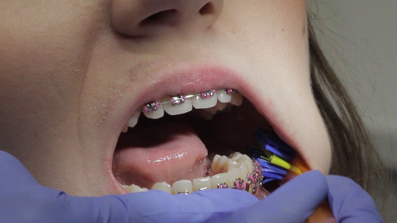 Ortodent.pl .Czyszczenie zębów z aparatem stałym