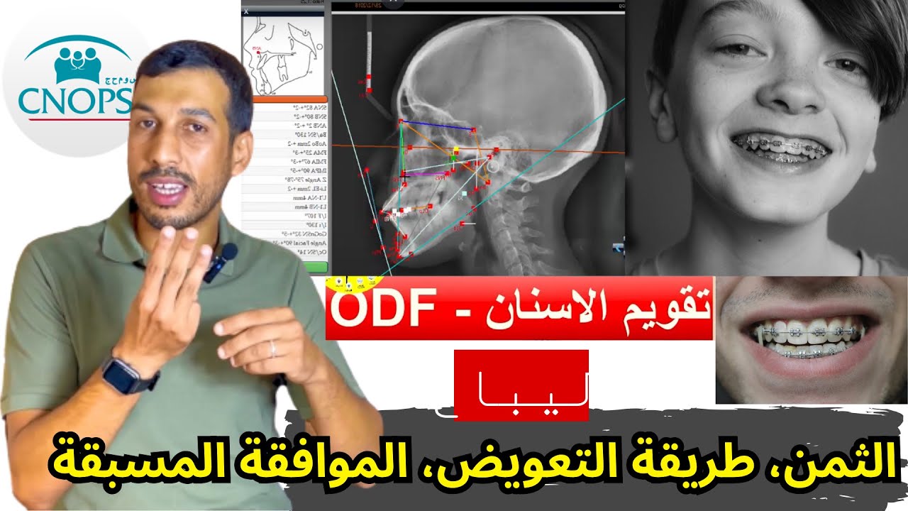 تعويض كنوبس تقويم الاسنان ليباغ الشروط التعويض analyse céphalométrique bilan ODF