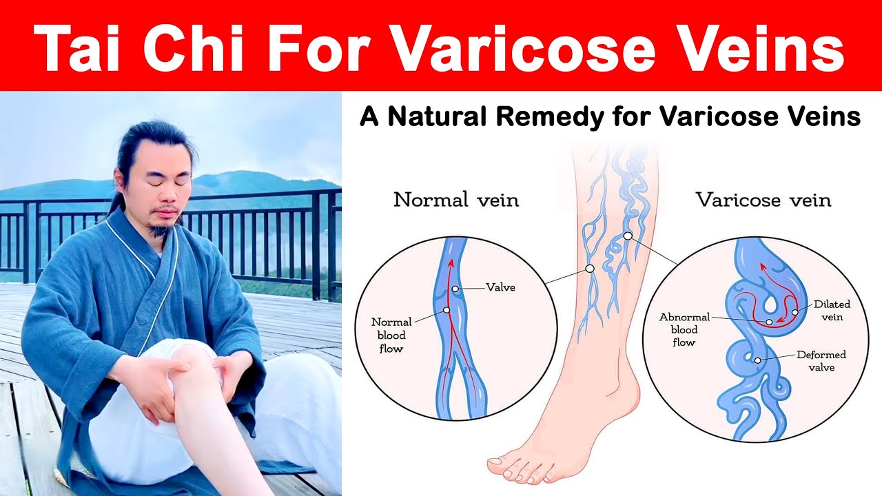Tai Chi for Varicose Veins Relief: Improve Leg Circulation Naturally