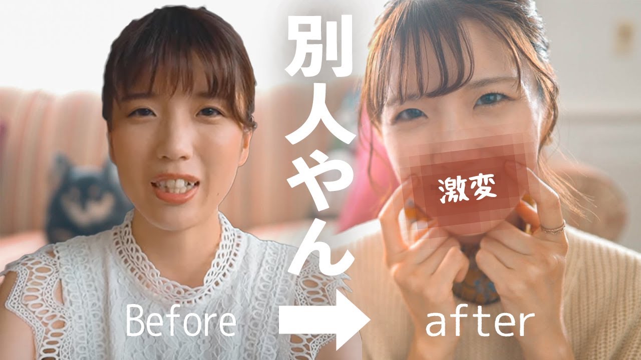 ついに歯列矯正終了！2年で口元ブスが整形並みに激変しました。()