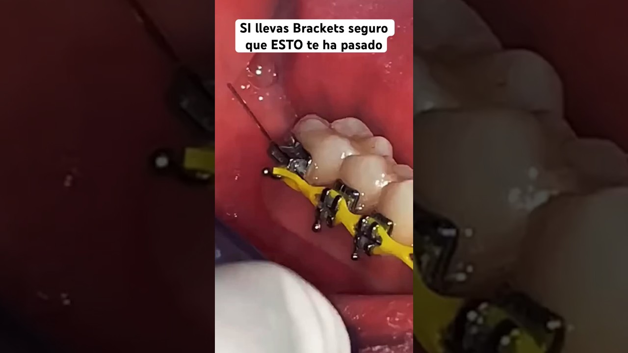 ¿Porque se te sale el alambre de los brackets?