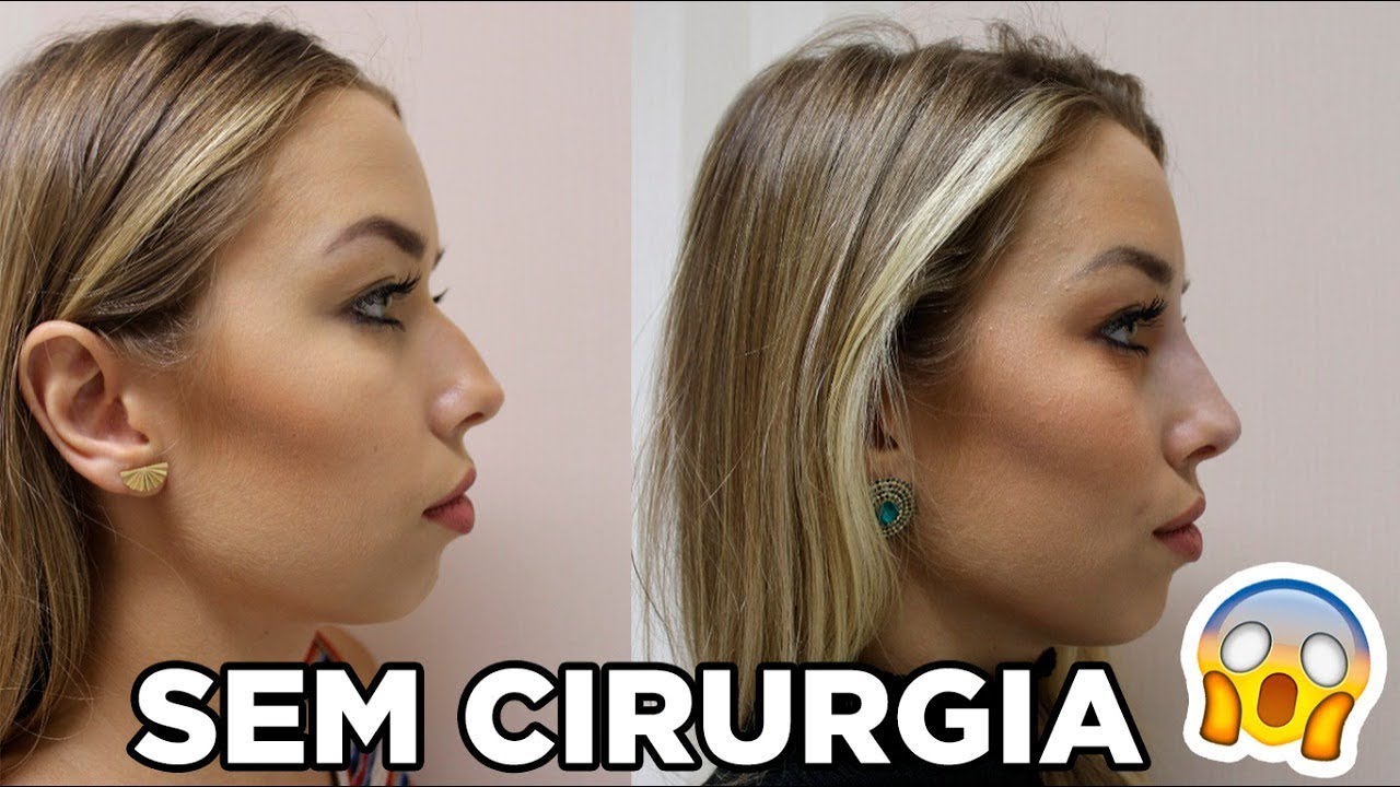 NARIZ PERFEITO SEM CIRURGIA | DÓI? VALOR? BIOPLASTIA?