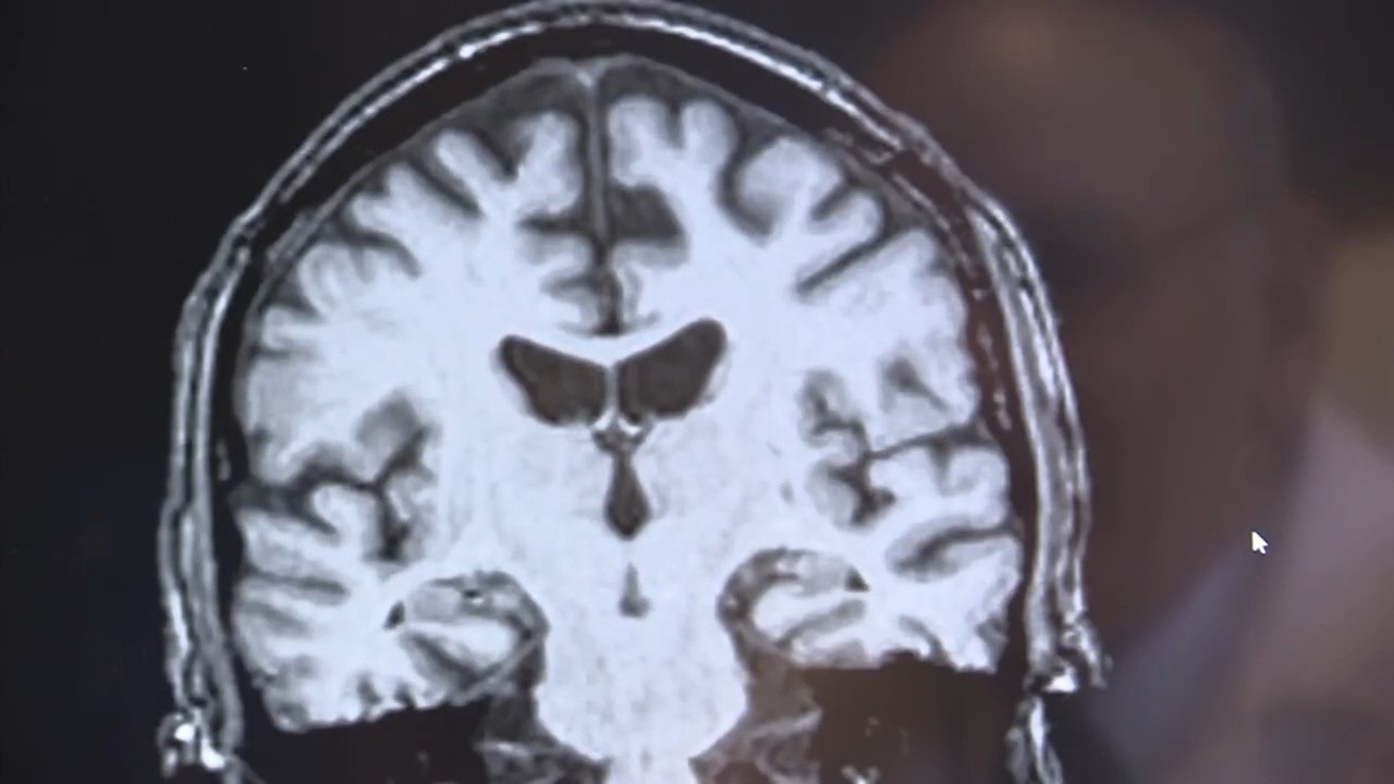 UCSD study: Simple blood test may predict dementia decades early