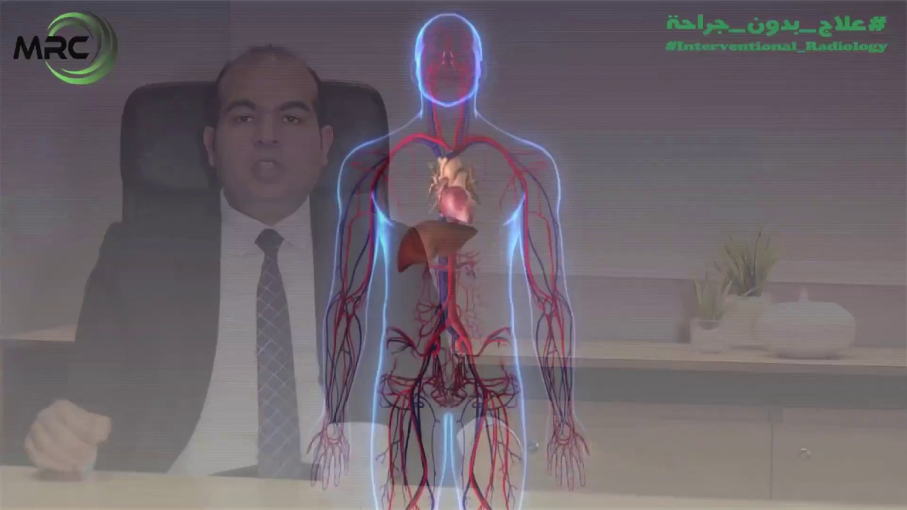 الحقن الكيماوي عن طريق القصطره الشريانيه لعلاج أورام الكبد- الأشعة التدخلية #علاج_بدون_جراحة