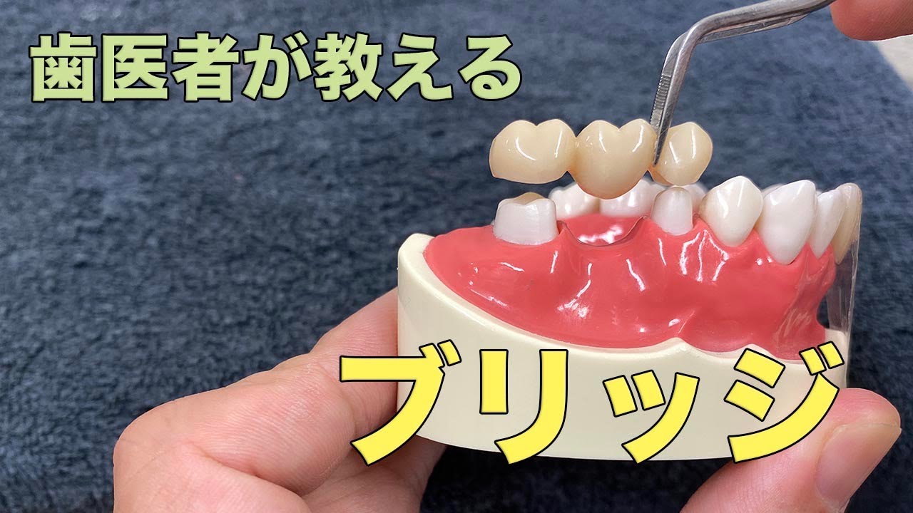 【横浜戸塚　内藤歯科】ブリッジ　歯を抜いた後の治療法の１つです。