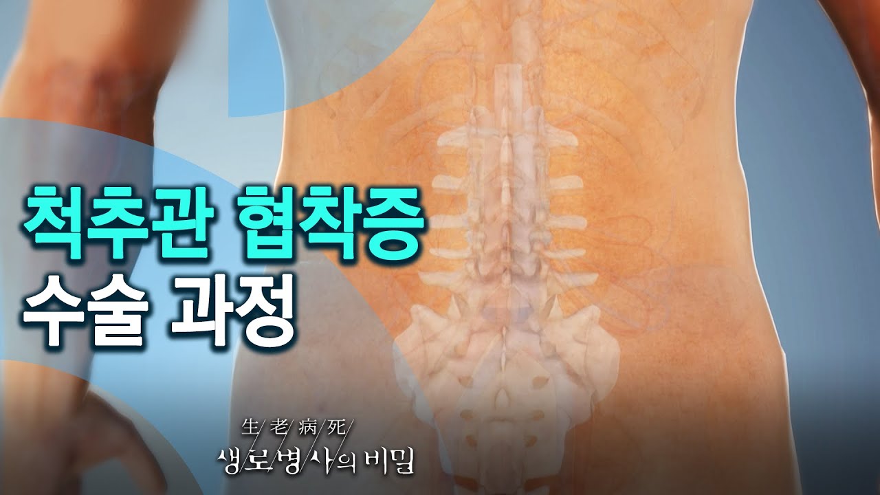 척추관 협착증 수술 과정_후방 요추 고정술 - 겨울철, 손발 저림 주의보 (KBS_761회_20210120)