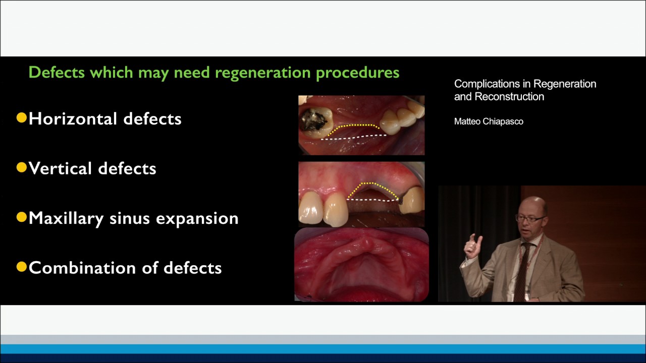 Complications in Regeneration and Reconstruction | Matteo Chiapasco