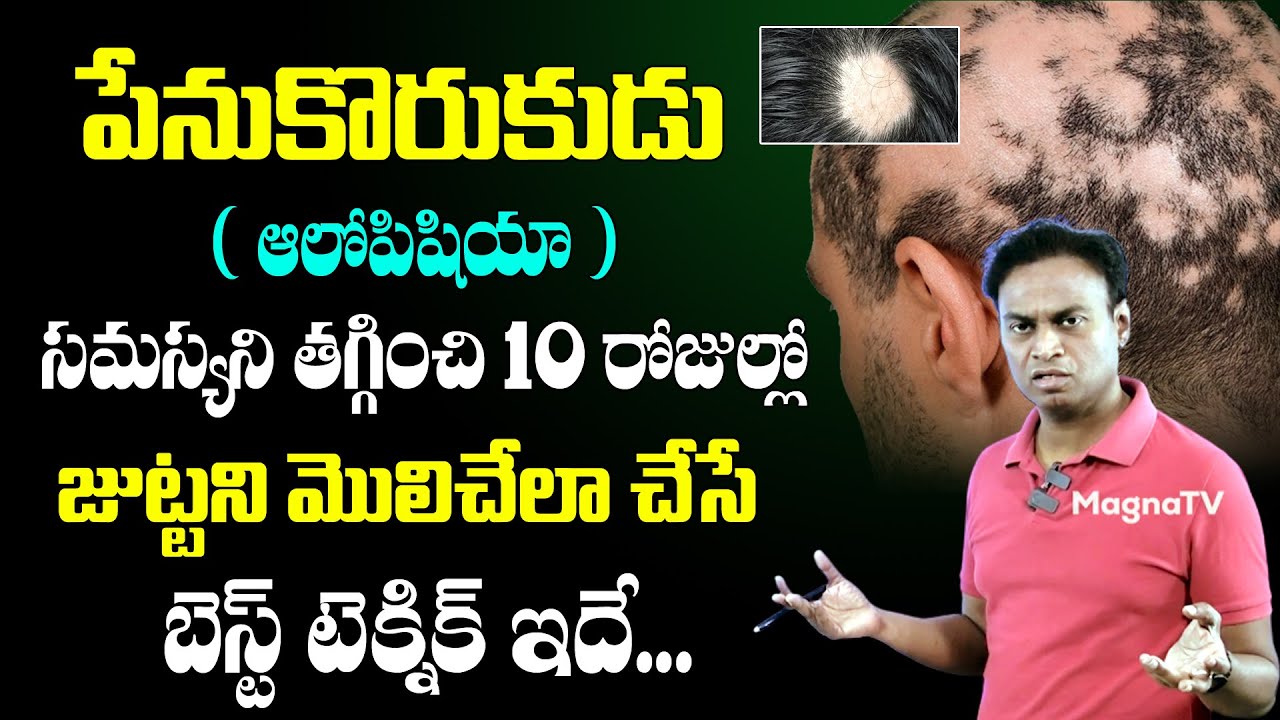 Alopecia Areata Signs, Causes | Alopecia Areata Natural Treatment | Dr.  Bharadwaz 