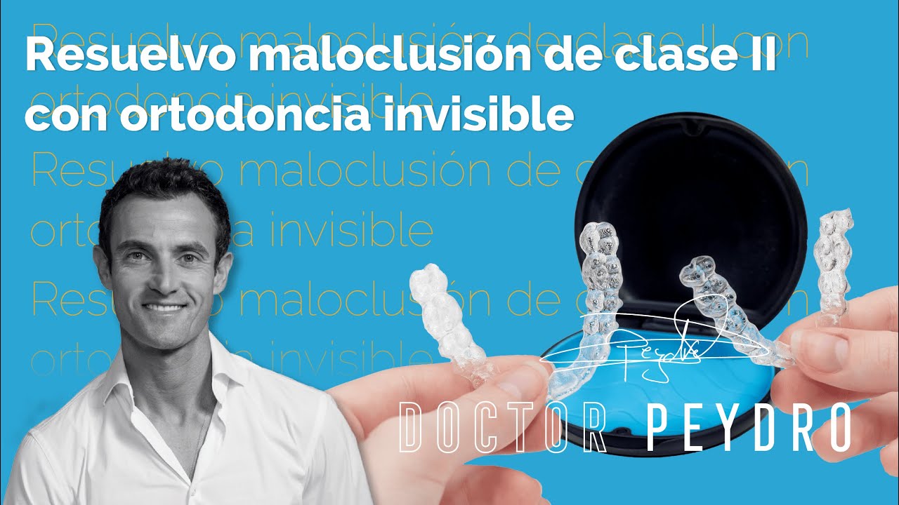 Maloclusión de clase II resuelta con ortodoncia invisible