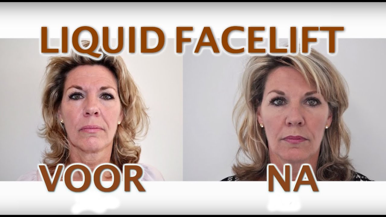 Nieuwsgierig naar de liquid facelift? | FURROW.NL