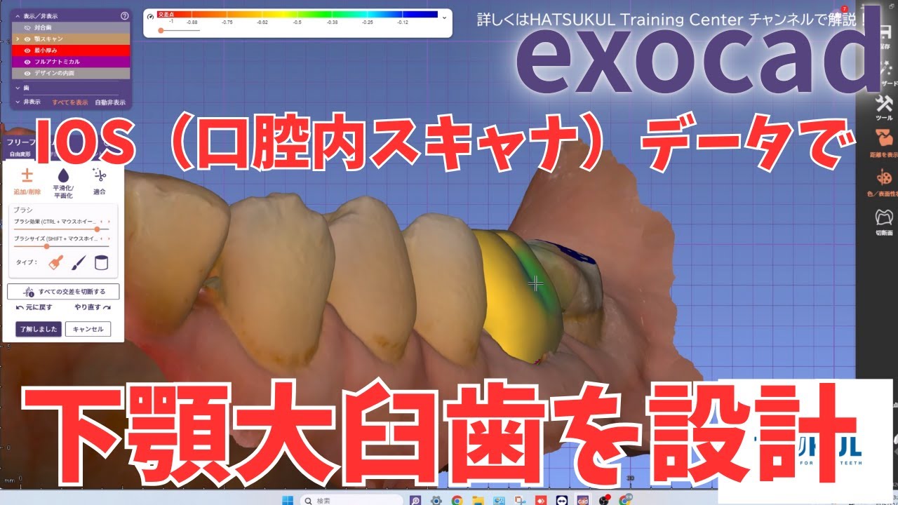 #303　exocad設計　IOS（口腔内スキャナ）データで下顎大臼歯を設計！（解説なし版）