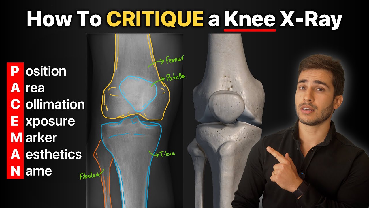 How To Critique a Knee X-Ray!