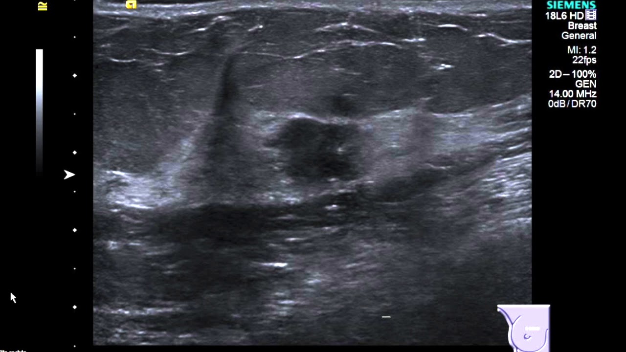 Breast Ultrasound   cancer 2