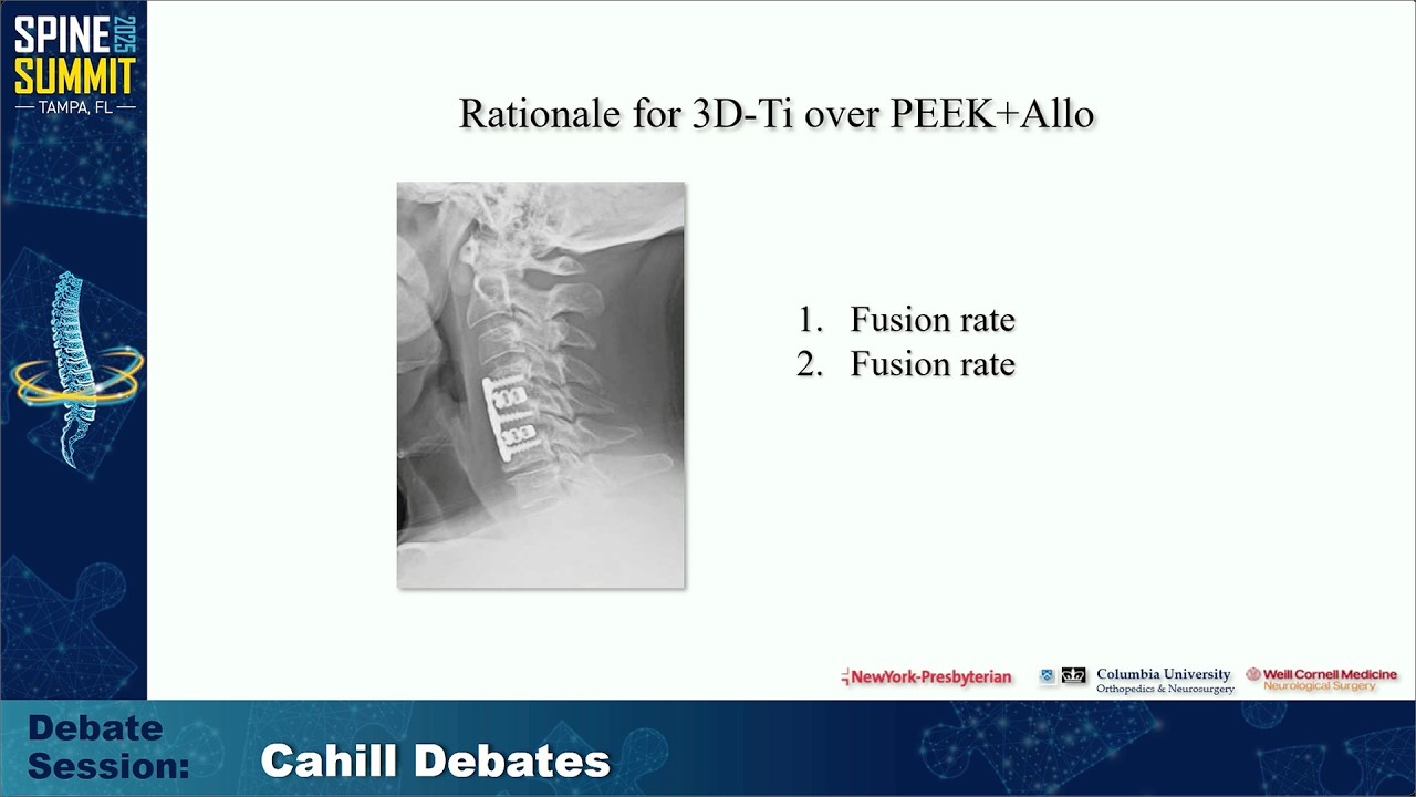 DSPN Spine Summit 2025 | Day 2 | 2 22 25 | Drs. Ghogawala & Riew | Cahill Debate: Titanium Cages