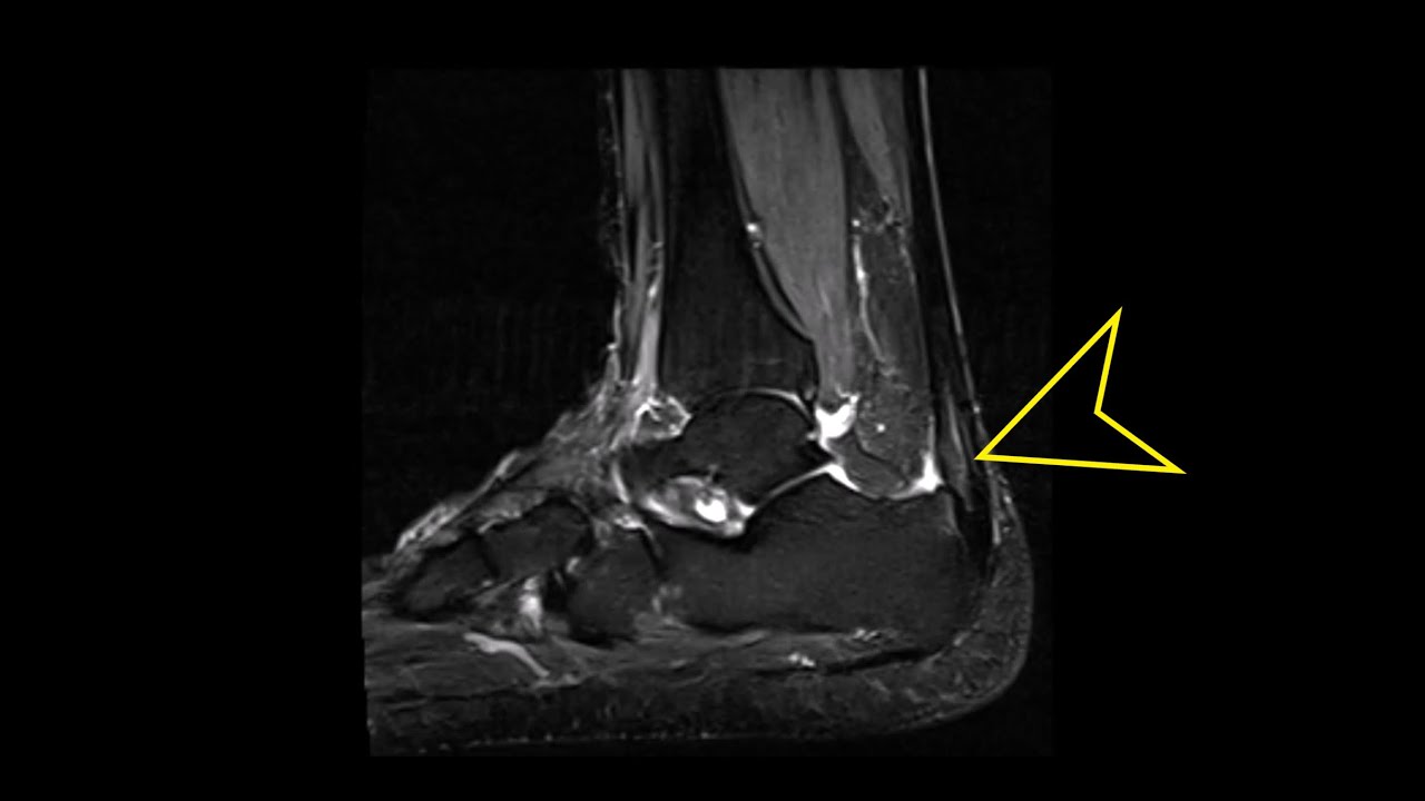 Ankle MRI: Haglund's Deformity, Achilles Tendinopathy