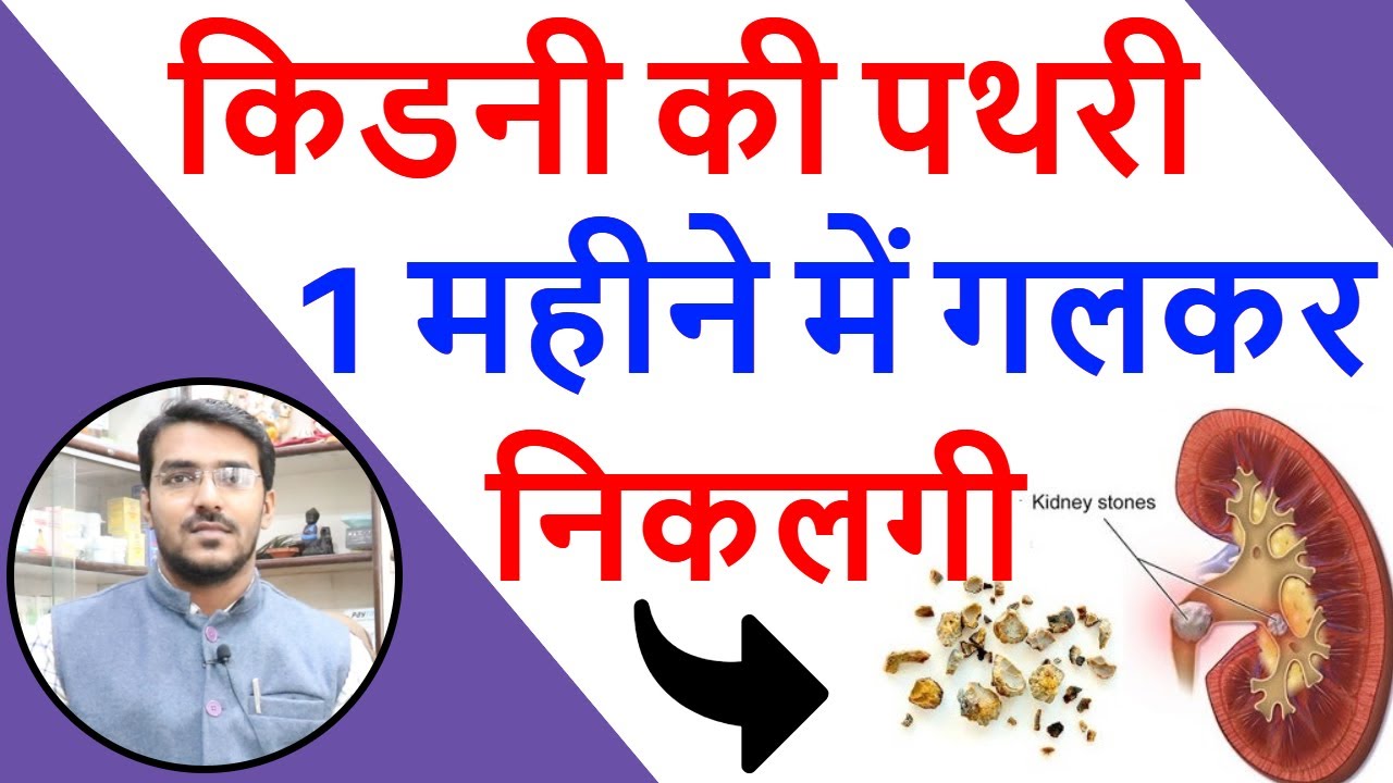 Kidney Stone का इलाज | Kidney ki pathri ka ilaj | Kidney Stone ka ilaj | Kidney Stone Treatment