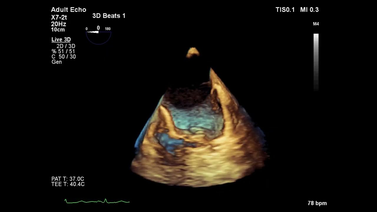 Unroofed Coronary Sinus: Rare Anomaly, Big Clinical Challenge