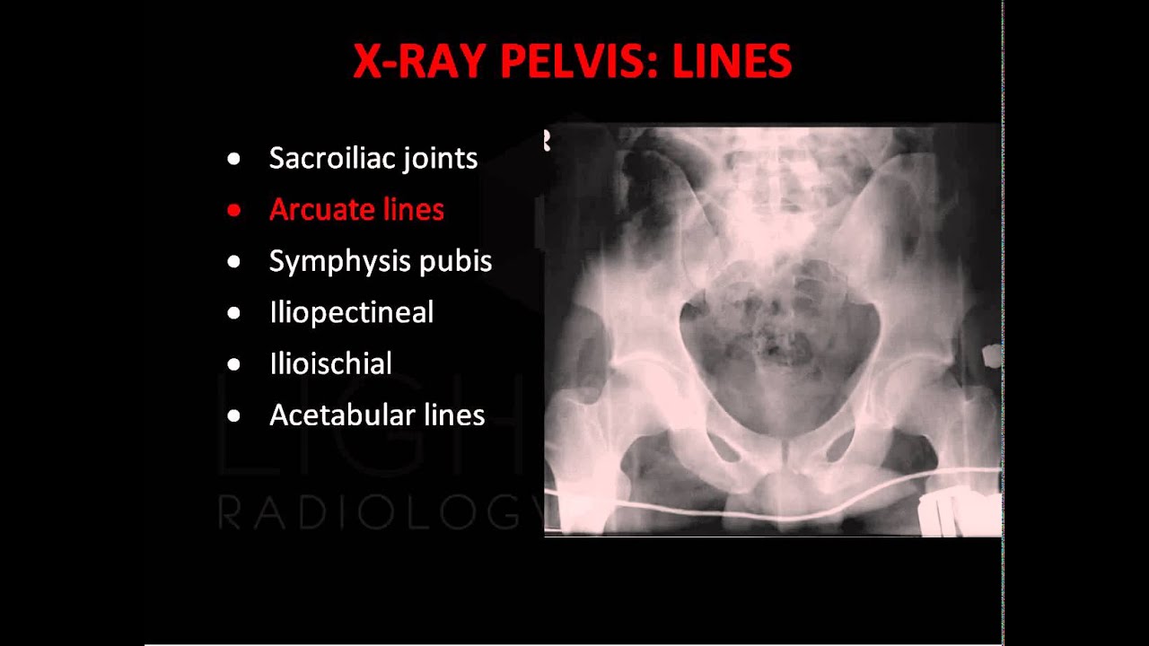 Emergency X-Ray Interpretation of the Pelvis