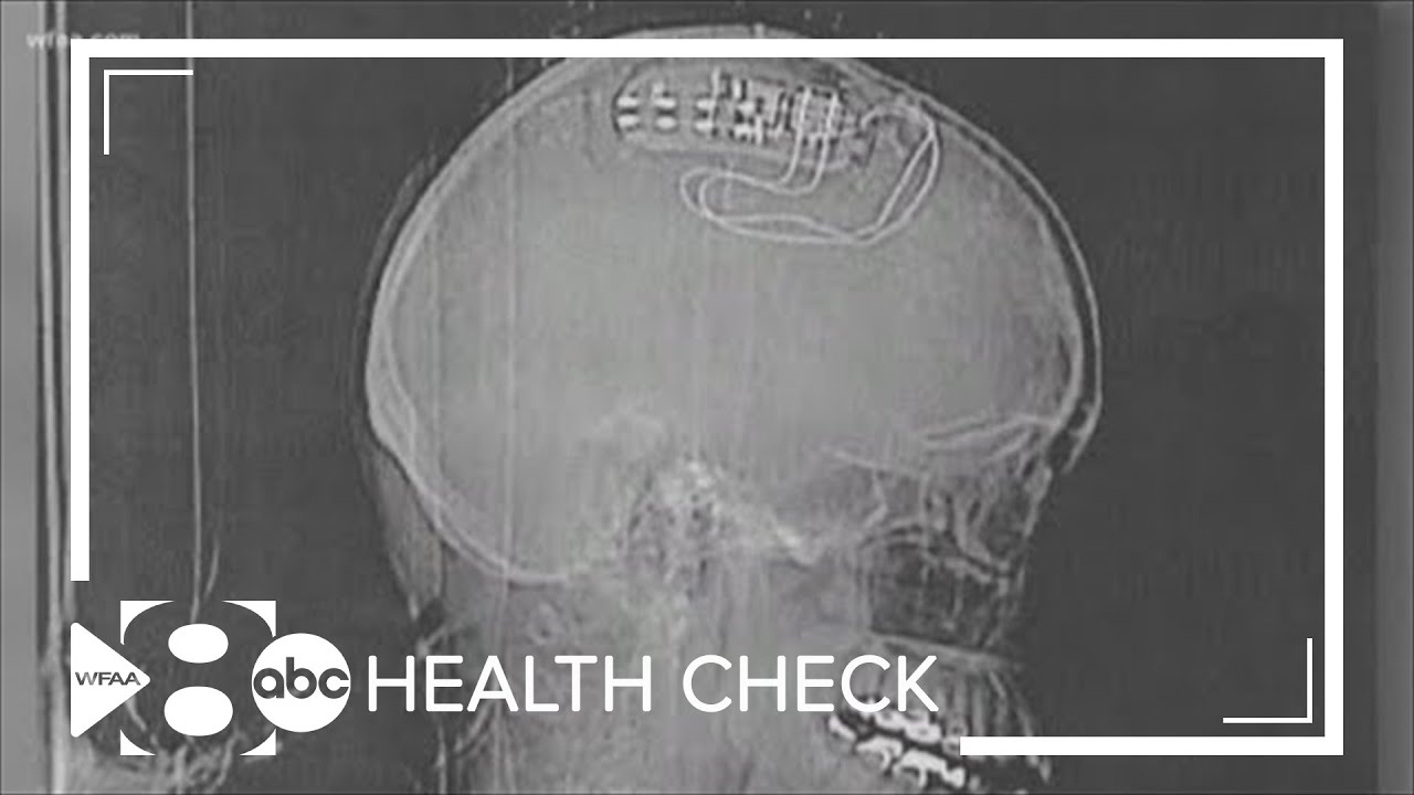 Health check: Device helps prevent seizures