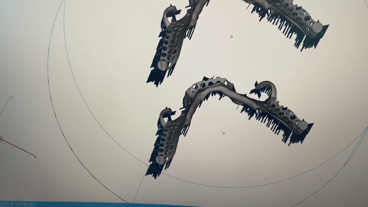 Dental RPD metal 3d printing