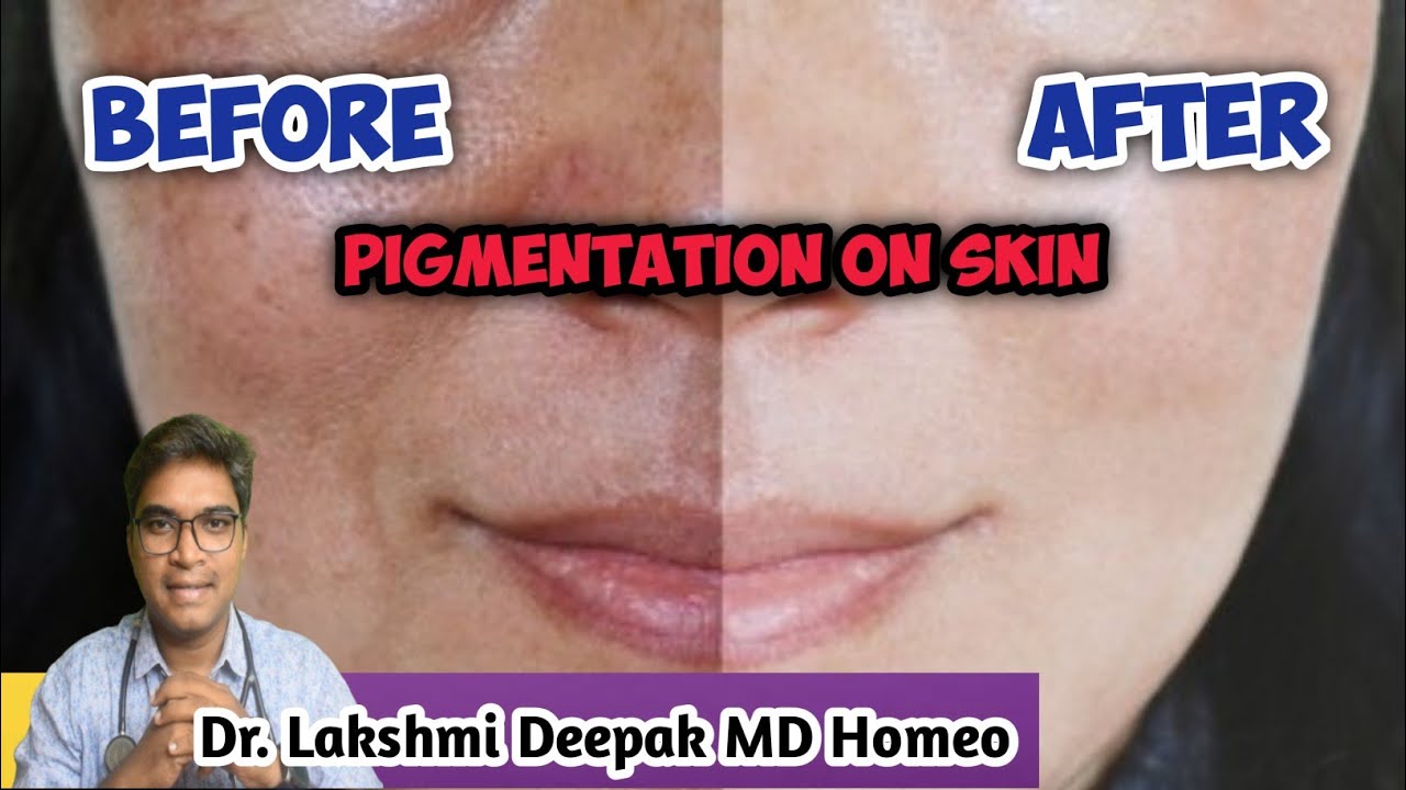 Reasons For Pigmentation On Face How To Remove Spots On Face Dark Spots on Skin Homeo Medicine