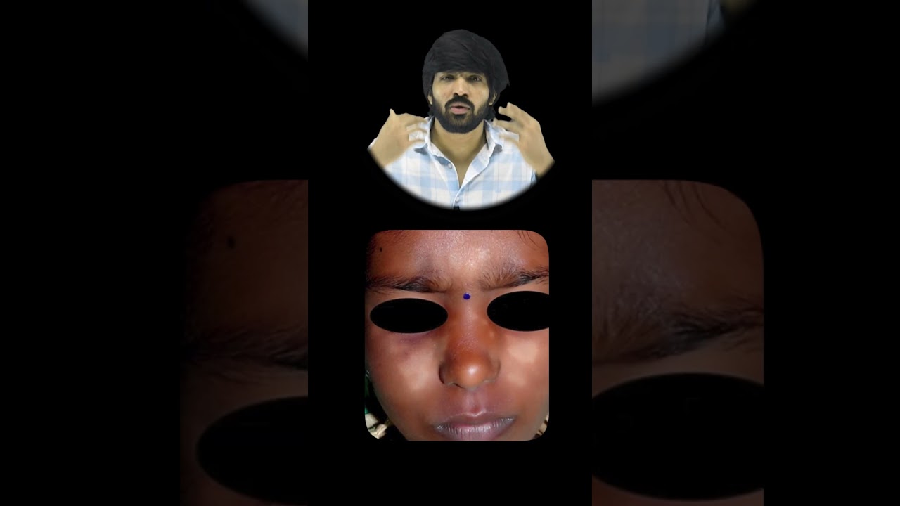 White Spot on Face