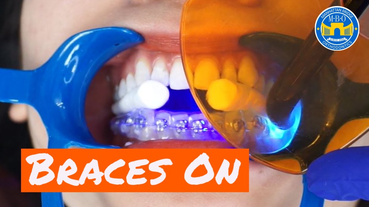 Fastest Way to Put on Braces - Indirect Bonding Technique