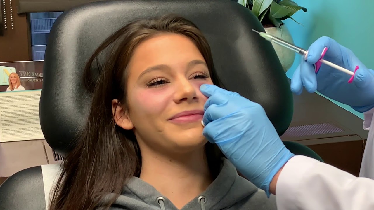 Tear trough eye bag correction with Volbella